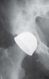 Illustration 4 for Mastering Hip Arthroplasty: Its Evolution and Design Unveiled