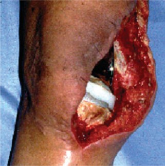 Illustration 10 for The Principles of Revision TKR: Avoid Pitfalls, Ensure Success