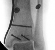 Illustration 28 for Tibial Fracture Extending into the Plafond: Intramedullary Secrets