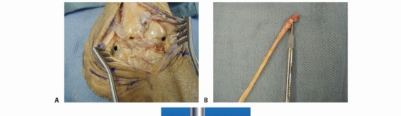 Illustration 19 for Lateral Ankle Repair: Maximize Stability with Interference Screw Fixation