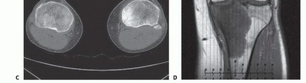 Illustration 8 for Tackling Complex Tumors of the Proximal Tibia: Limb-Sparing Solutions