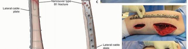 Illustration 26 for Mastering Fixation of Periprosthetic Fractures of the Femur