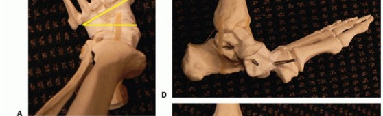 Illustration 15 for Regain Mobility: Surgical Solutions for Charcot Foot Arthropathy