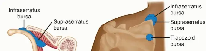 صورة توضيحية لـ متلازمة احتكاك لوح الكتف: الدليل الشامل للعلاج والتعافي في اليمن والخليج