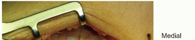 Finally End Golfer's Elbow Pain: Open Treatment of Medial Epicondylitis