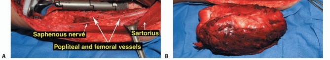 Illustration 51 for Advanced Distal Femoral Resections: Limb-Sparing Outcomes & Techniques