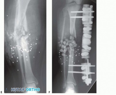 Illustration 35 for Tibia External Fixation: See How Pins Are Placed for Healing