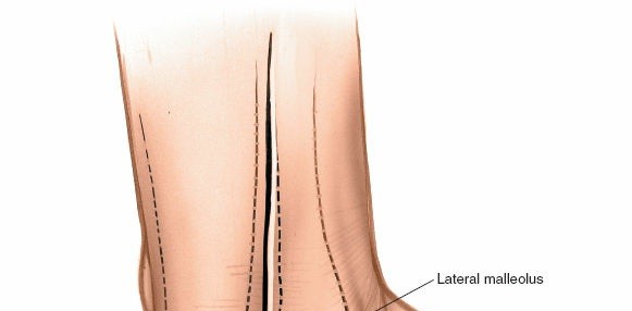 Illustration 62 for Optimized Approaches to the Dorsum of the Foot & Ankle