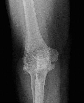Illustration 81 for Right Shoulder Pain? Avoid This Common X-ray Mistake.