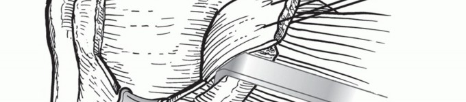 Illustration 12 for Latarjet for Instability: Bone Loss Solutions, Per Burkhart SS, Lo