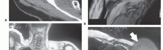 Illustration 15 for Limb-Sparing Resections Around the Shoulder: Optimizing Outcomes