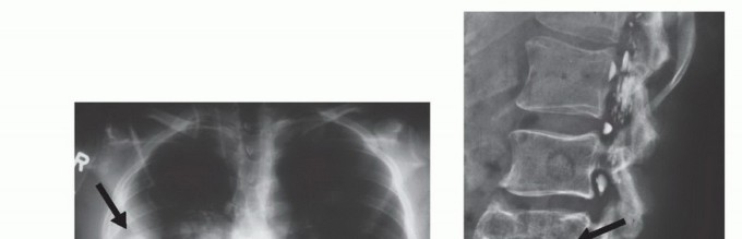 Illustration 22 for Precision Biopsy of Musculoskeletal Tumors for Accurate Diagnosis