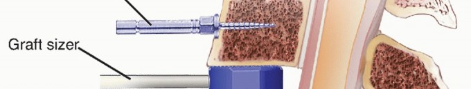 Illustration 21 for How ACDF Clears Your Posterior Disc Space for Lasting Relief