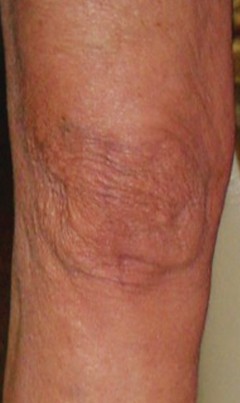 Illustration 15 for Minimal Incision Total Knee: Experience Faster Healing