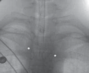 Illustration 5 for Mastering Pediatric Shoulder Fractures: Clinical Insights