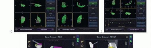 صورة طبية: استبدال مفصل الركبة الجزئي: حل متقدم لآلام الركبة المستمرة مع الأستاذ الدكتور محمد هطيف