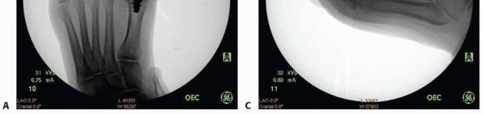Illustration 52 for End Articular Cartilage Loss: Arthrosurface HemiCAP Resurfacing