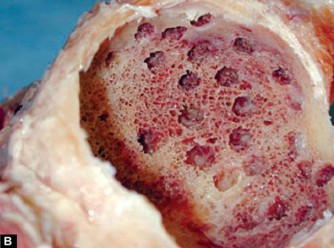 Illustration 10 for Optimizing Acetabular Component Cementation for Superior Outcomes