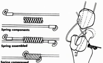 Illustration 28 for Sliding Trochanteric Osteotomy: Modern Role & Refined Techniques