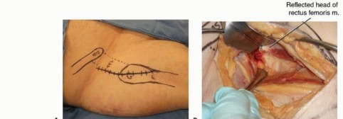 Illustration 14 for Is a Sliding Hip Screw Best for Your Femoral Neck Fracture?