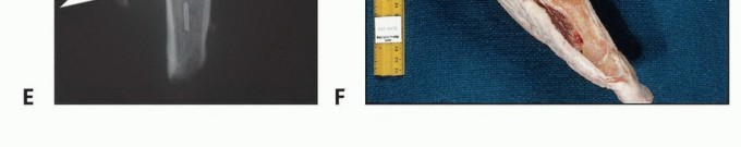 Illustration 13 for Below-Knee Amputation: Maximize Your Below-Knee Recovery & Function