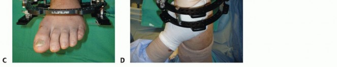 Illustration 52 for Optimize Pain Management with Proximal Ring Block for Ankle Arthrodesis