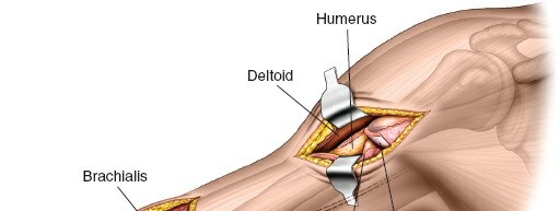 Illustration 25 for Mastering the Approach to the Distal Humerus: Safety & Skills