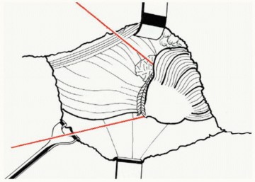 Illustration 24 for Sliding Trochanteric Osteotomy: Modern Role & Refined Techniques