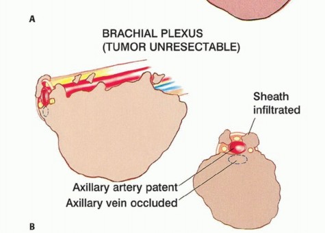 Unresectable tumor