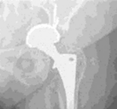 Illustration 3 for Mastering Severe Bone Loss: Highly Porous Metal for Revision THA