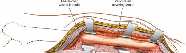 Illustration 24 for Optimal Femoral Approaches: Mastering the Lateral Intermuscular Septum
