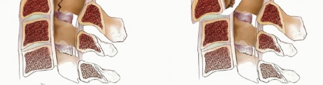 Illustration 16 for Master Techniques for Cervical Fracture Reduction: Type III & More