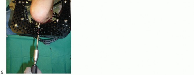 Illustration 48 for Optimize Pain Management with Proximal Ring Block for Ankle Arthrodesis