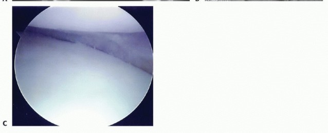Illustration 5 for Symptomatic Knee? Meniscal Transplant for Anterior & Posterior Horns