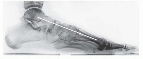 Illustration 3 for Fixation of Lisfranc Injuries: Essential Open Reduction Guide