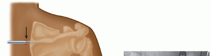 Illustration 20 for Snapping Scapula Syndrome: Why Your Shoulder Clicks & What to Do