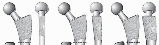 Why Double-Tapered Primary Stems Deliver Lasting Stability