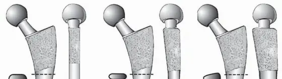 صورة توضيحية لـ السيقان المخروطية المزدوجة في مفصل الورك: ثبات يدوم لسنوات طويلة مع الأستاذ الدكتور محمد هطيف