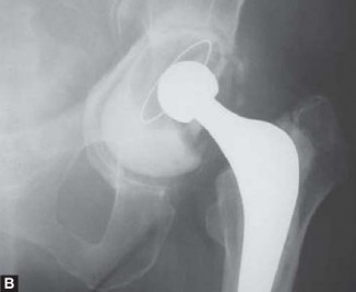 Illustration 34 for Optimizing Acetabular Component Cementation for Superior Outcomes