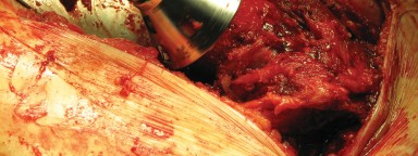 Illustration 50 for Figure Hip Resurfacing: Who Benefits and Who Should Avoid It?