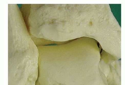 Endoscopic Treatment of Posterior Ankle: Relief Awaits!