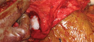 Illustration 55 for Hinged Total Knee: The Salvage Solution for Challenging Cases