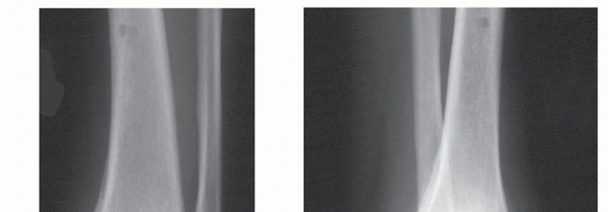 Illustration 6 for Beyond Amputation: Circular Fixation for Infection of the Talus