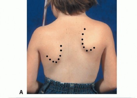 Modified Woodward Repair: Fixing High Elevation of the Scapula
