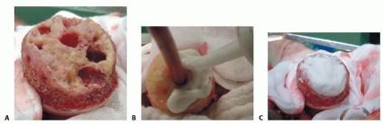 Illustration 16 for Hip Resurfacing: The Bone-Sparing Solution around the Femoral Head