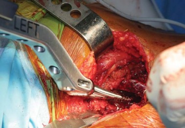 Illustration 34 for Kinectiv® Stem: Modular Necks for Primary THA Success