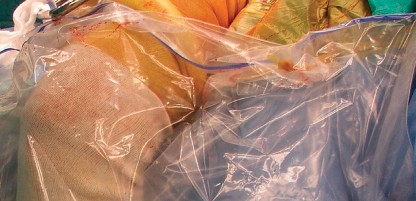 Illustration 17 for Cementless Femoral Stems: Master Indications & Avoid Pitfalls