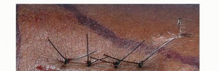 Illustration 17 for Distal Radius Fixation: Precision Through Lister's Tubercle