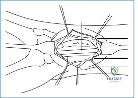 Illustration of must be taken - Dr. Mohammed Hutaif
