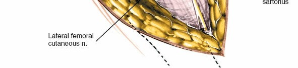 Illustration 27 for Unlocking Every Aspect of the Hip's Surgical Approaches